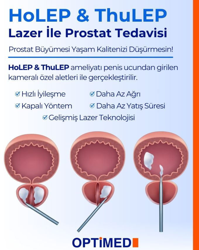 Prostat tedavisinde ileri lazer teknolojisi Optimed Sağlık Grubu’nda